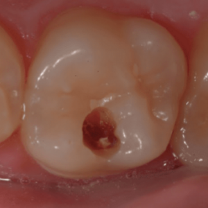 Лікування каріесу